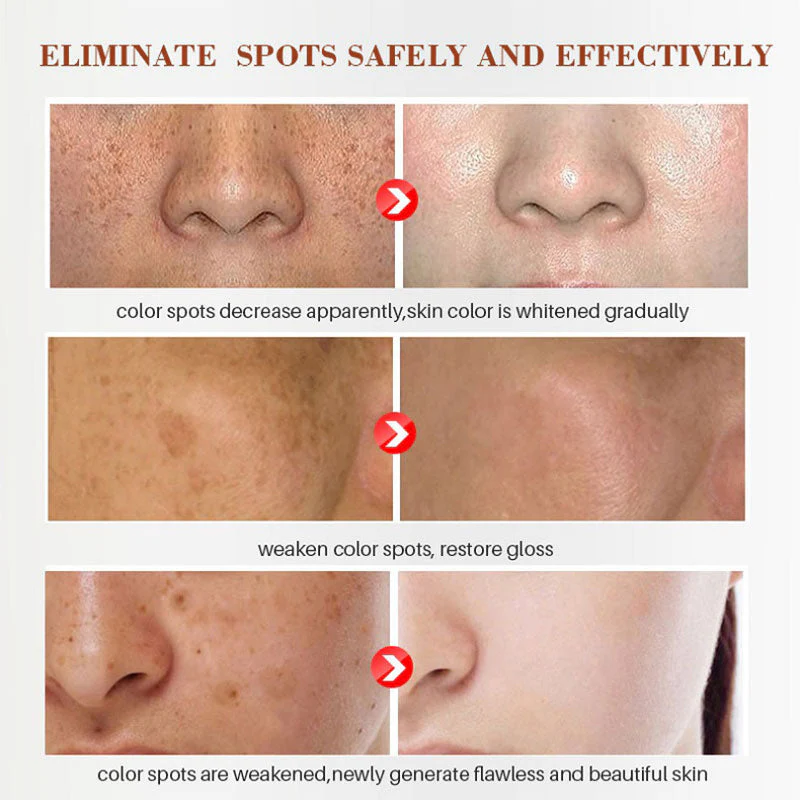 Plant lightening melanin freckle cream - Image 5