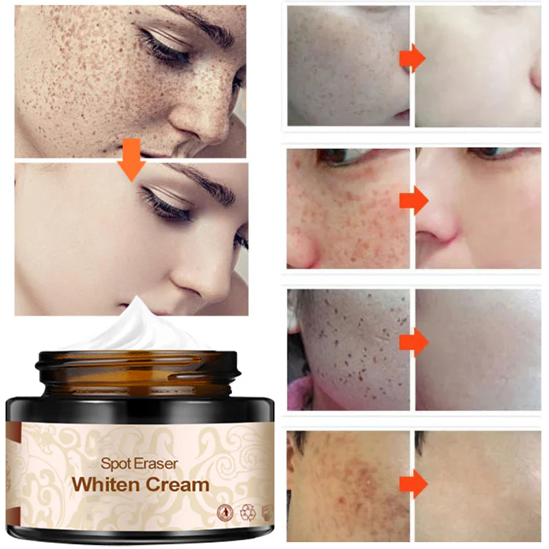Plant lightening melanin freckle cream - Image 8