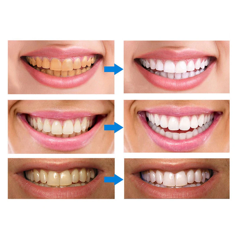 Teeth Whitening Pens - Image 3